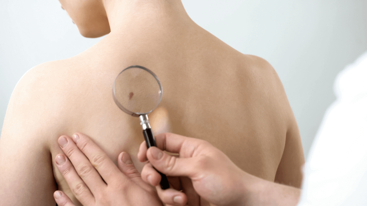 Patientin mit Hautkrebsvorstufe vor ihrer Behandlung mit photodynamischer Therapie bei Dr. Ständer bei Memmingen.