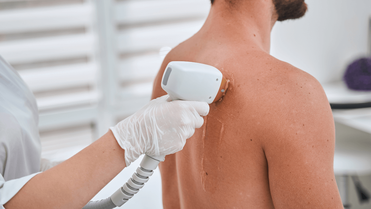 Patient bekommt störende Hautveränderung durch Laser entfernt.
